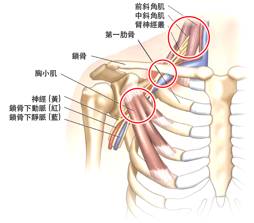 王凱平醫師 聯新國際醫院運動醫學中心主治醫師 胸悶 呼肌不順還手麻 復健卻沒效 小心可能是胸廓出口症候群